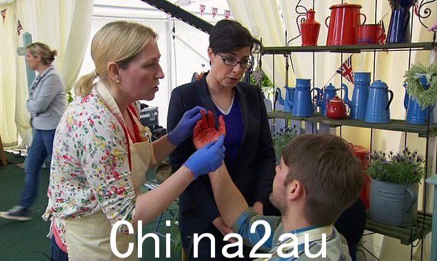 这位明星面包师的手臂上流着血,但他得到了一位恰好也是医生的参赛者的帮助