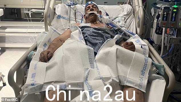 Culbertson 被咬了 300 处,缝合了 500 处,割伤了 100 处。后来他在医院感染化脓,最终不治身亡