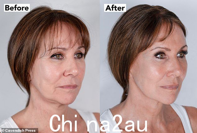 Linda Lusardi 接受了价值 3,850 英镑的非手术整容手术,并说她看起来“年轻了 10 岁”