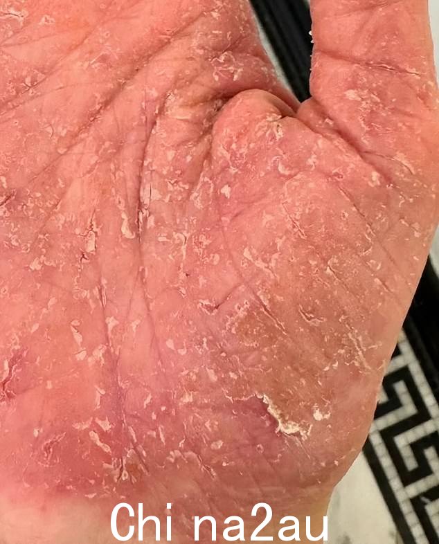 她手掌的照片显示了她所经历的极度剥落和刺激,包括干燥皮肤裂开的血腥裂缝