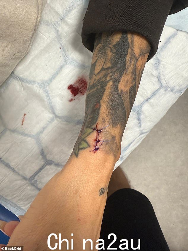 The former glamour model, 47, had to get stitches after she accidentally stabbed herself in the hand while whipping up a chicken curry