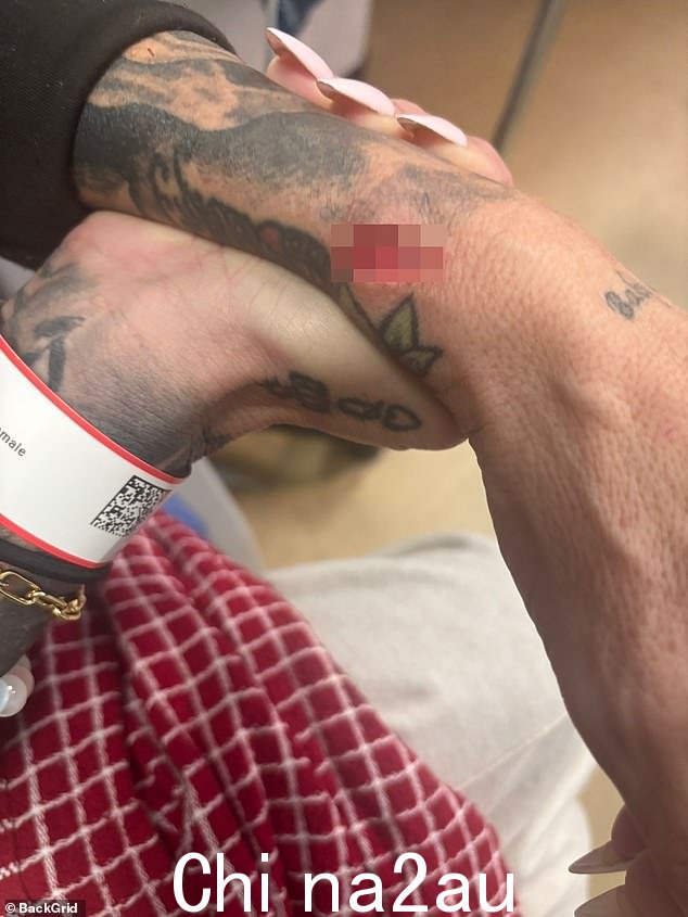 Revealing the seriousness of the gory injury, she explained that the knife had ripped through her ligaments and nerves, leaving half her hand numb.
